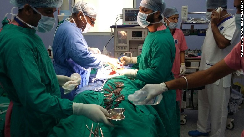 Doctors removed 40 knives from a man's stomach in India.