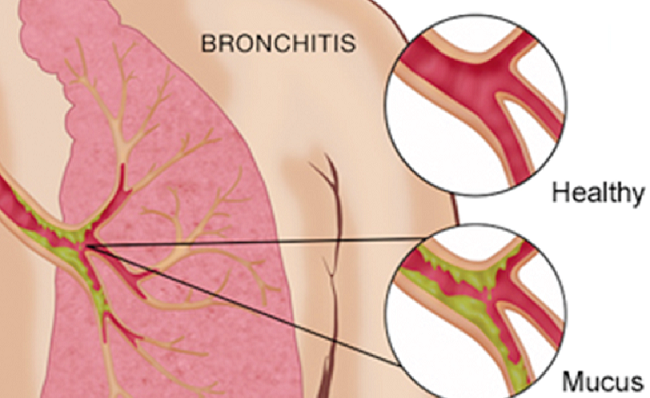 Symptons of chronic bronchitis 