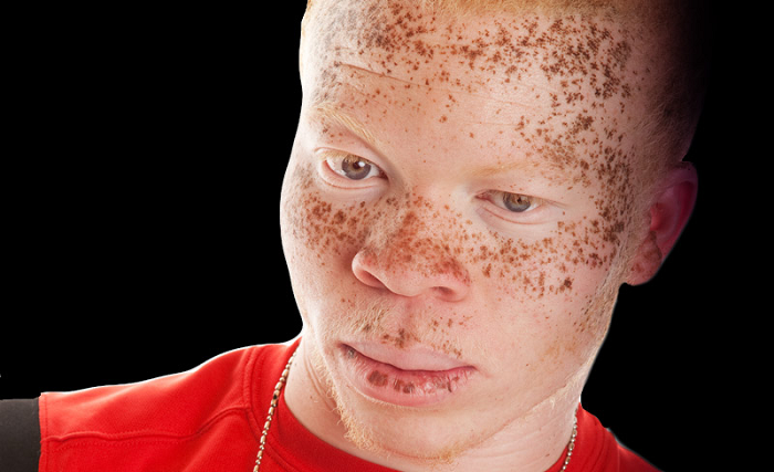 Albinism: My complexion or my person?