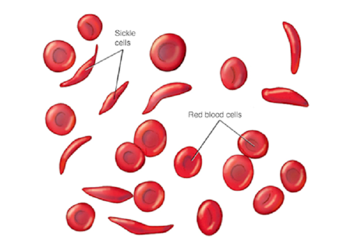 World Sickle Cell Day - Need for public awareness