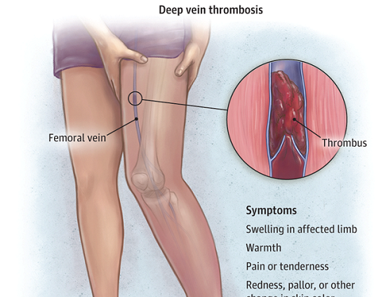 Deep vein thrombosis and diet