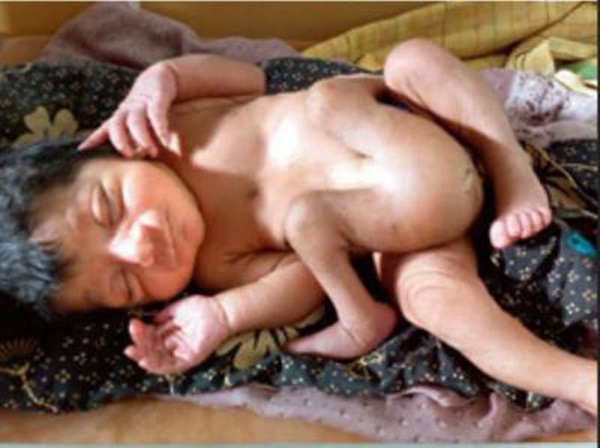 The boy was born with four legs (Picture: Times of India)