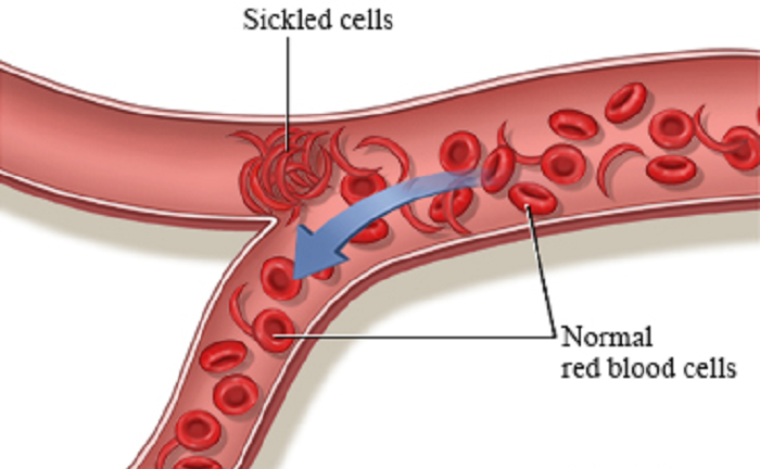 Medical officer reignites discussion on cure for sickle cell