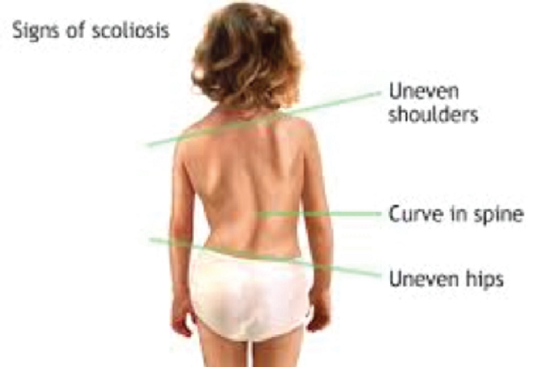 All you need to know about scoliosis