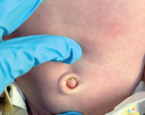 An umbilical granuloma is an overgrowth of tissue during the healing process of the belly button