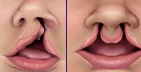Cleft lip and palate (CLP) is the commonest birth anomaly affecting the face of newborn babies.