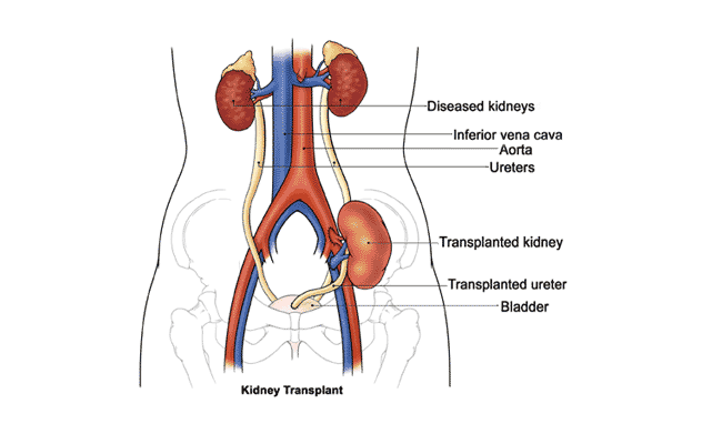 Road to the first kidney transplant in Namibia 