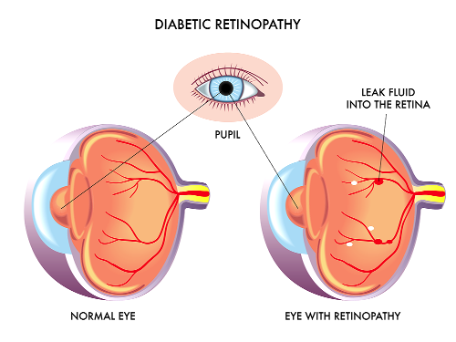 diabetic eye