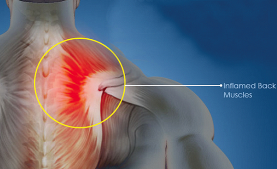 Spondylosis may affect any part of your spine-neck, upper and lower back