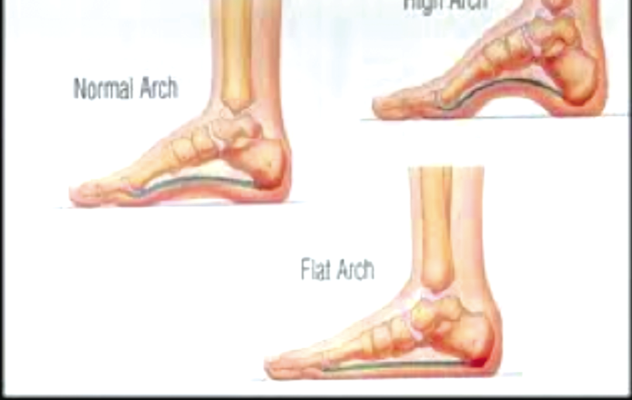 What are the symptoms of flat feet 
