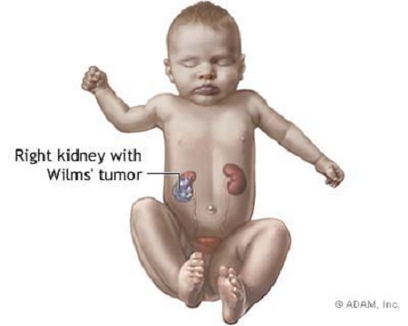 Wilms tumour
