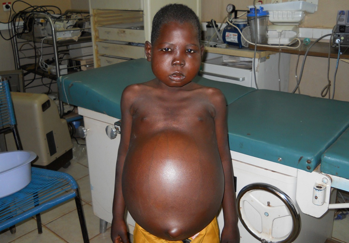 Nephrotic syndrome can also result from a systemic diseases - secondary causes. examples of such diseases include diabetes mellitus, lupus erythematosus, hepatitis B, HIV, malaria and sickle cell disease. 