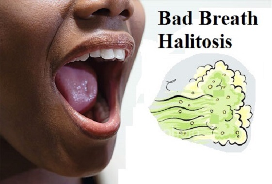 halitosis - bad breath