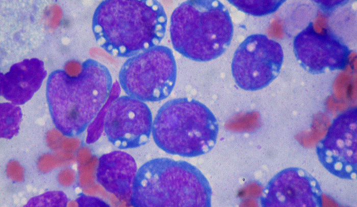 Burkitts lymphoma  — A cancer in children 