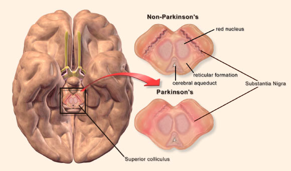 A bump into Parkinson’s Disease