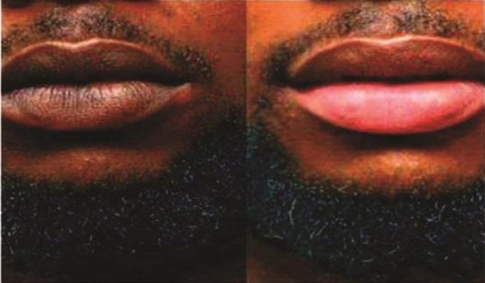 FDA warns against use of harmful 'pink-lips' creams