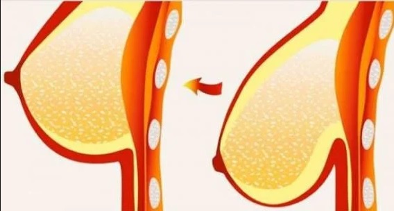 Seven remedies for sagging breasts