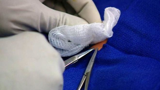 Italy: Toddler dies from circumcision at migrant centre