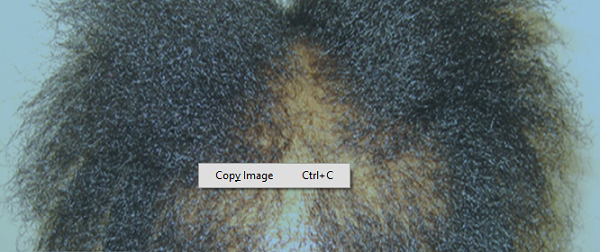 Poor nutrition may be a major factor in hair loss