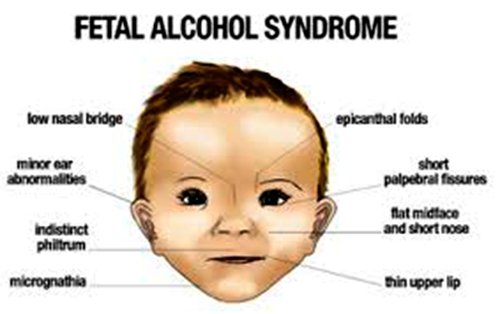 Foetal Alcohol Syndrome; A creeping danger