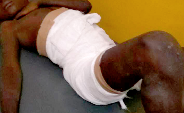 The burnt boy in hospital