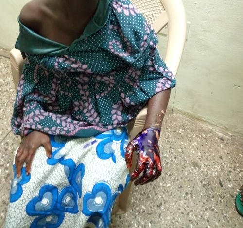 Grandmother ‘roasts’ girl's hand for stealing meat from soup