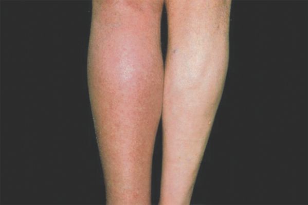 If one of your legs look bigger than the other or appear warm and discoloured, then you should see a doctor.