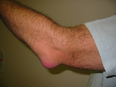 How elbow sprain occurs
