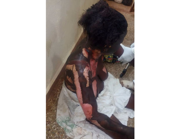 Woman roasts sister-in-law with petrol in fight over baby custody