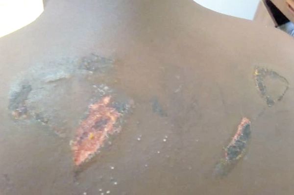 The Nana Asamoah Korang with machete wounds inflicted on him by the masked men.