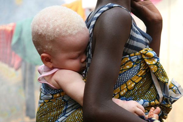 Albinos receive no support from PWDs fund — GLOWA