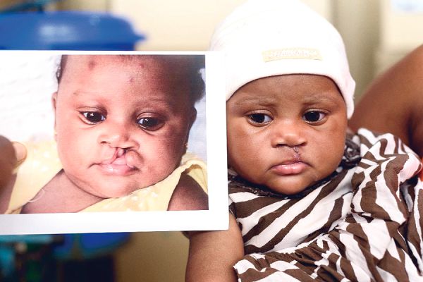  A patient with cleft lip before surgery (left) and after surgery