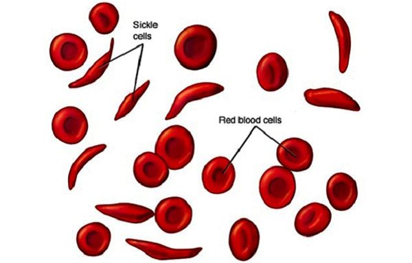 Sickle Cell is preventable
