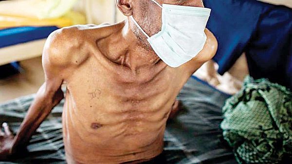 We can stop TB