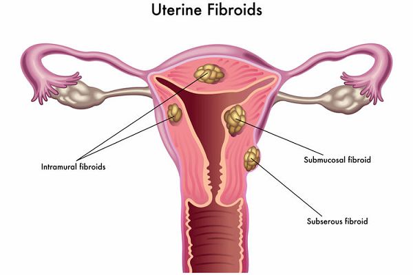 Fibroid not caused by sex, contraceptives