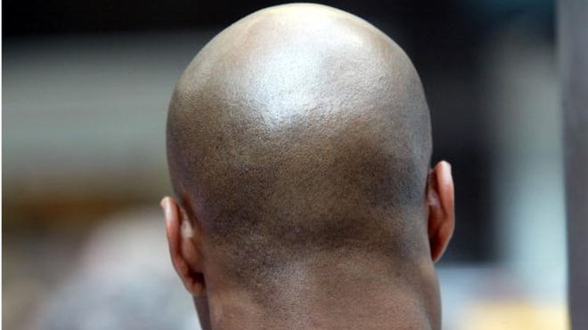 "Air pollution could make you bald"