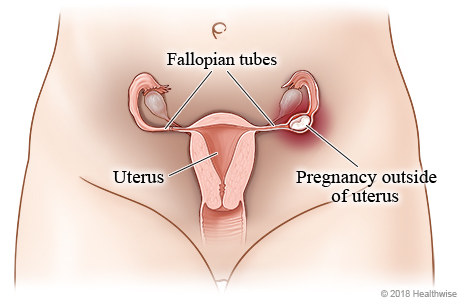 Fair women at a higher risk of ectopic pregnancy, research finds