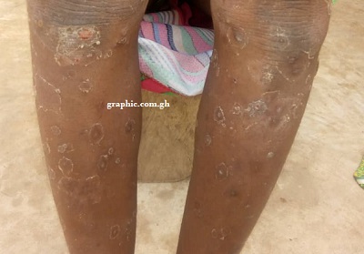 Gambaga residents undergo five-day Mass Drug Administration to control scabies