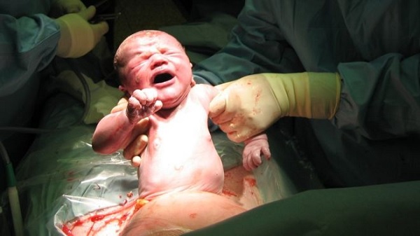 Caesarean delivery