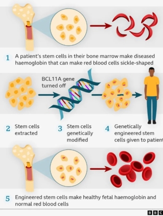 UK NHS to offer £1.65million 'groundbreaking' sickle cell gene therapy