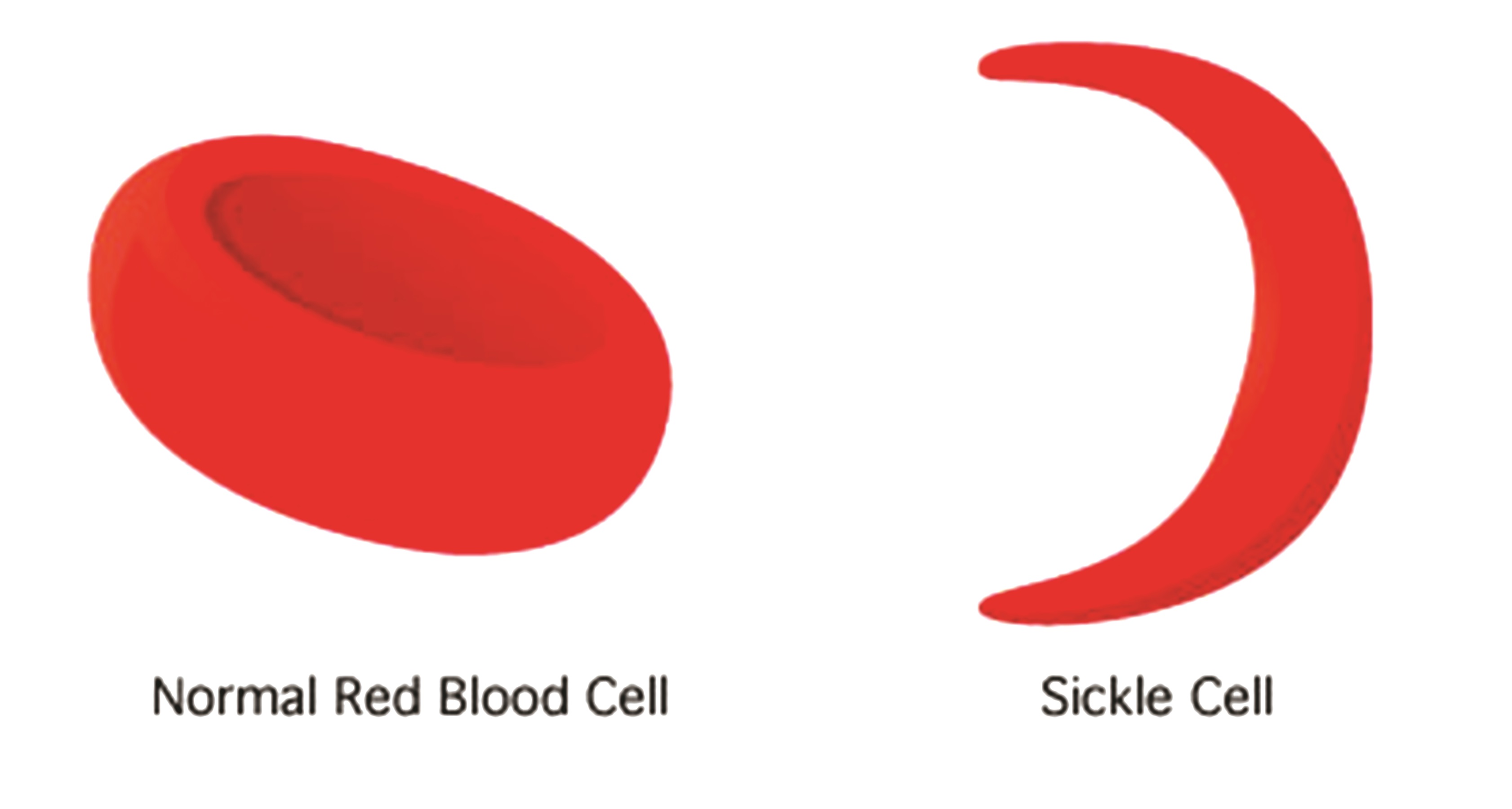 Sickle cell disease - Myths and facts