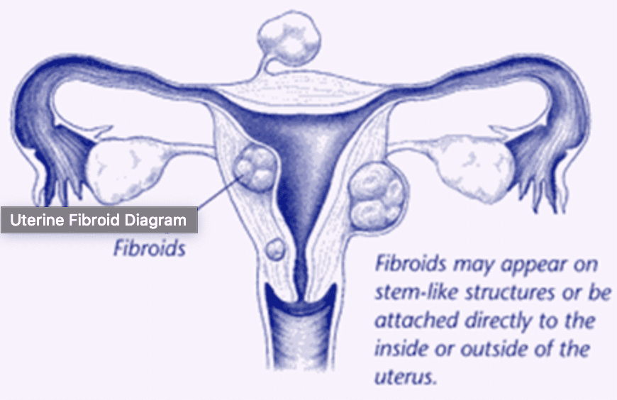 Break the silence on fibroids