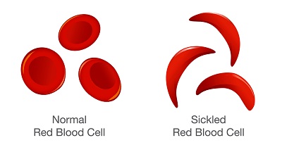 The underlying abnormality in sickle cell disease is that the red blood cells (RBC's) are abnormally shaped.
