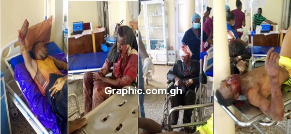 Omaro Belo with the severed wrist, and his other injured colleagues 