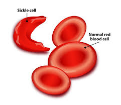 Meet the sickle cell warriors