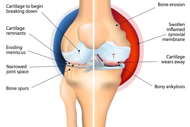 Physio management of rheumatoid