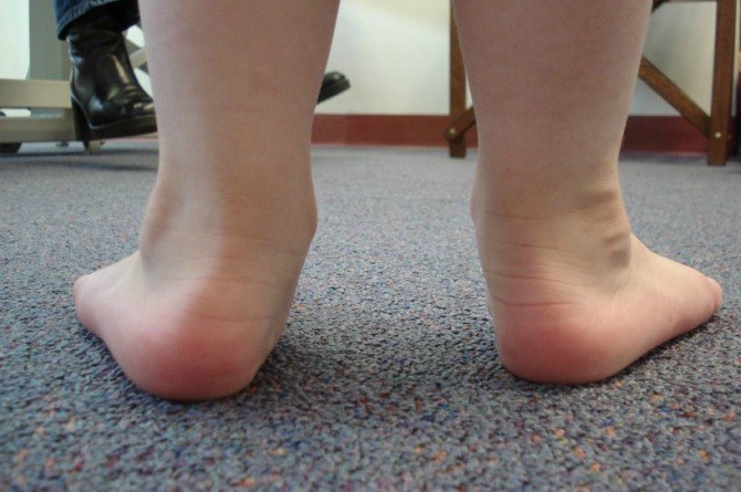 Flat foot in children 