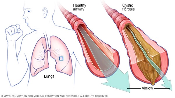 Cystic fibrosis is a hereditary disease that affects the lungs and digestive system