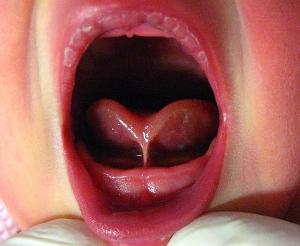 Tongue tie is a frequent complaint encountered at the newborn clinics