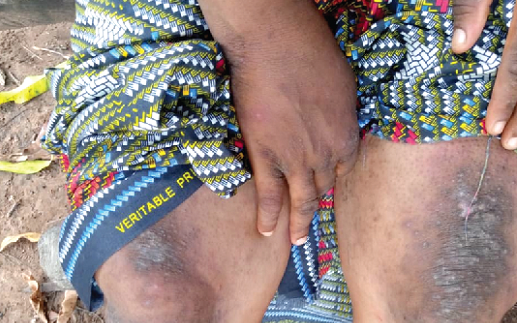 A woman showing the rashes around her knees